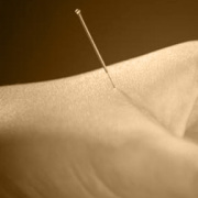 Bi Syndrome – Treatment of pain with Acupuncture